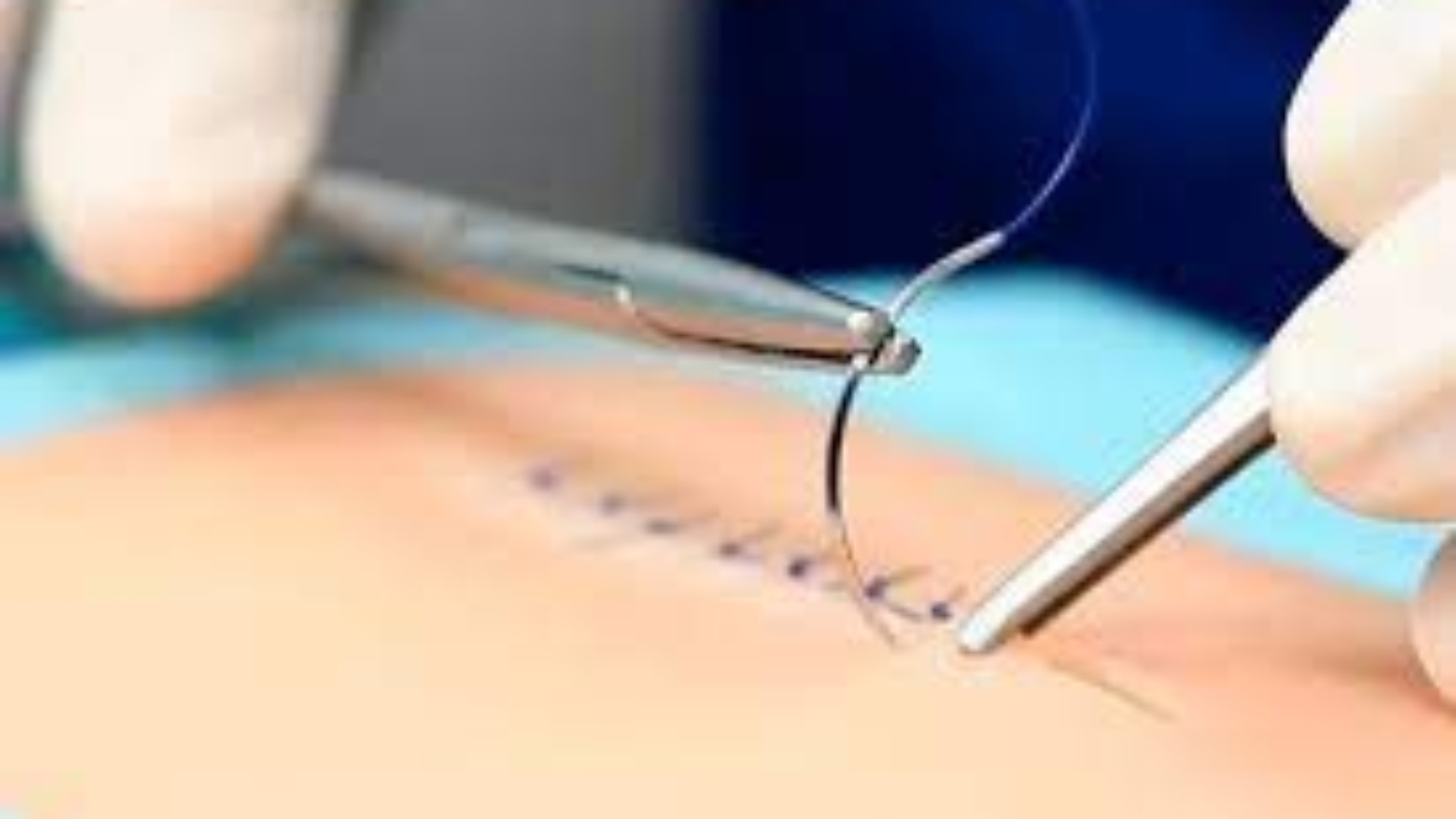 surgical procedure in playa del carmen