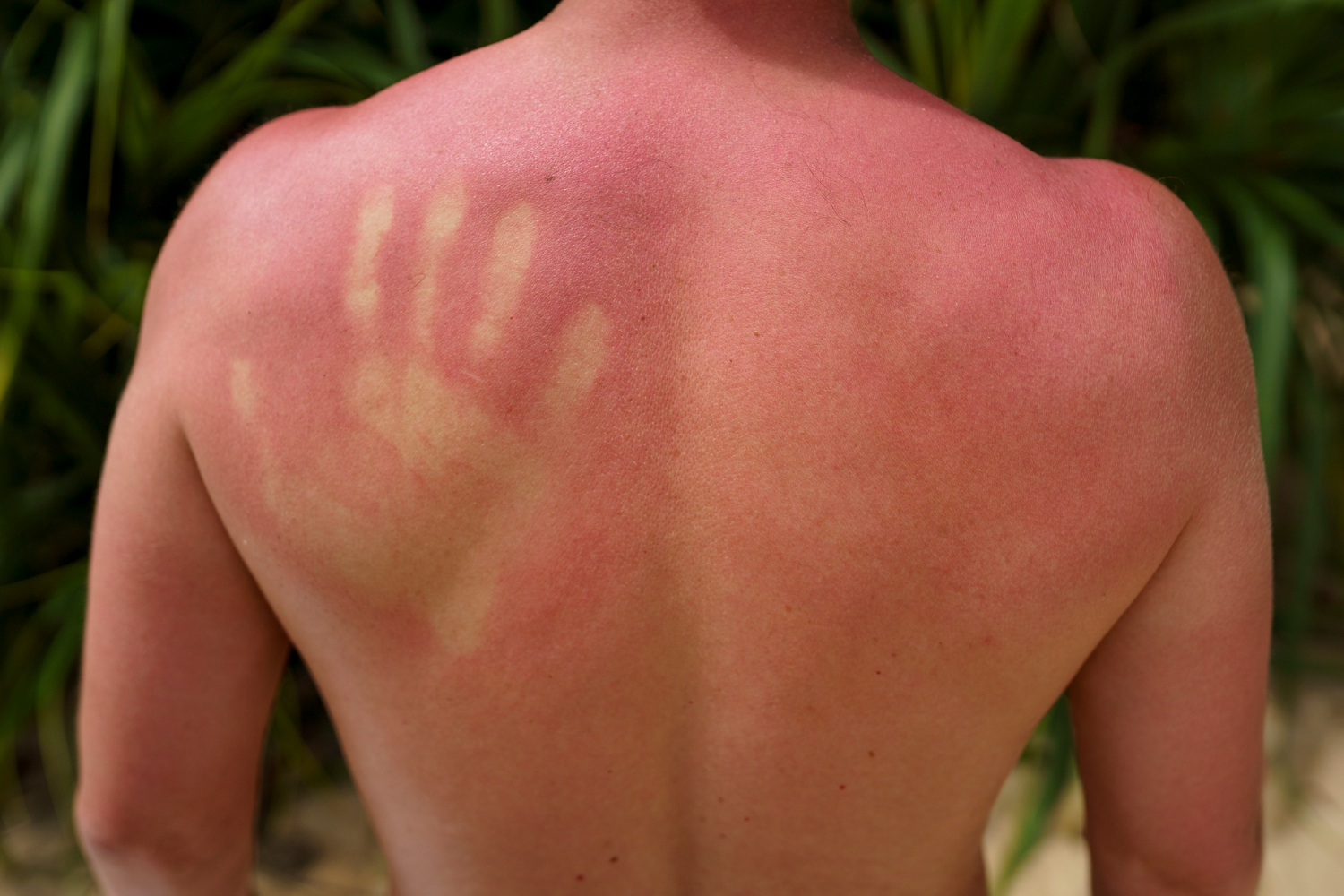 Sunburns or skin rashes