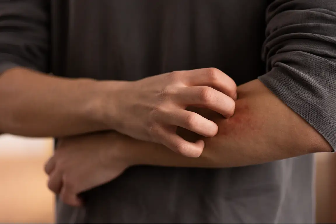 Insect bites and stings